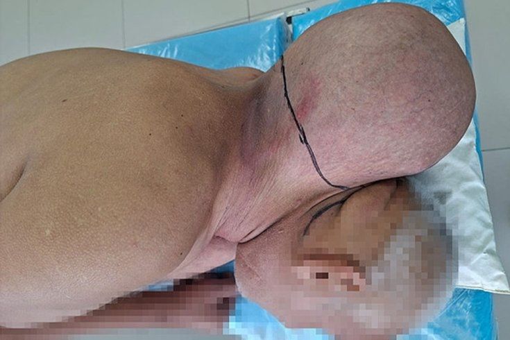 65 яшьлек ир-атның муеныннан баш зурлыгындагы шешне алганнар