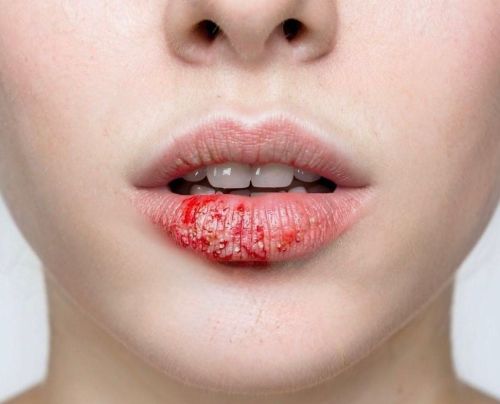 Ирендәге герпестан тиз котылу чарасы