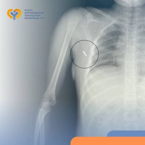 Кечкенә кызның култыгына терекөмешле градус үлчәгеч очы кадалып кергән